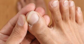 Comment soigner un panari naturellement ?