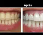 Comment enlever le tartre sur les dents naturellement ?