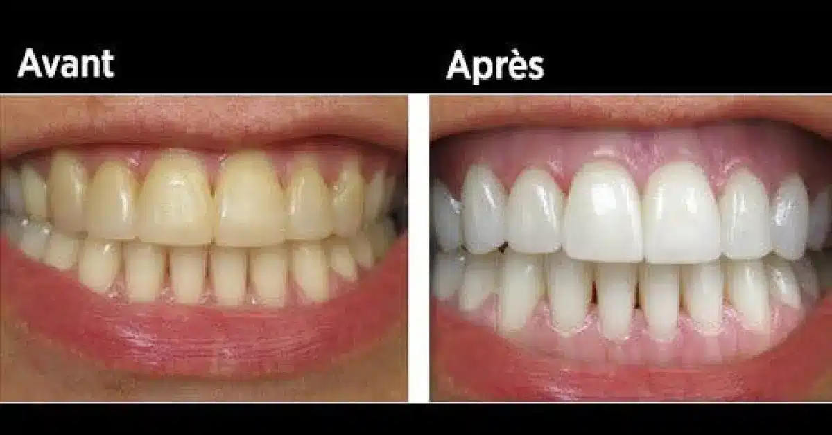 Comment enlever le tartre sur les dents naturellement ? Blog House